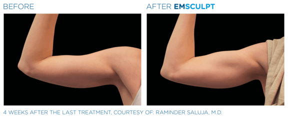 emsculpt-neo-vorher-nachher-06-info-aesthetik.png 