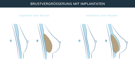 Graphik Brustvergrößerung, info Ästhetik