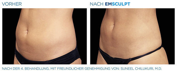 emsculpt-vorher-nachher-01-info-aesthetik.jpg 