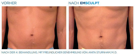 emsculpt-vorher-nachher-05-info-aesthetik.jpg 