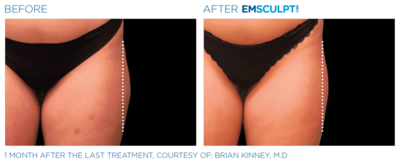 emsculpt-neo-vorher-nachher-09-info-aesthetik.png 