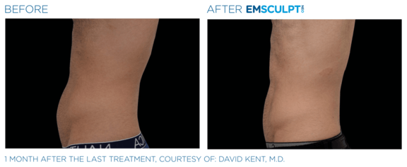 emsculpt-neo-vorher-nachher-07-info-aesthetik.png 