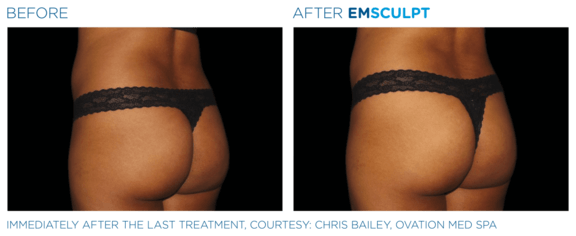 emsculpt-neo-vorher-nachher-03-info-aesthetik.png 