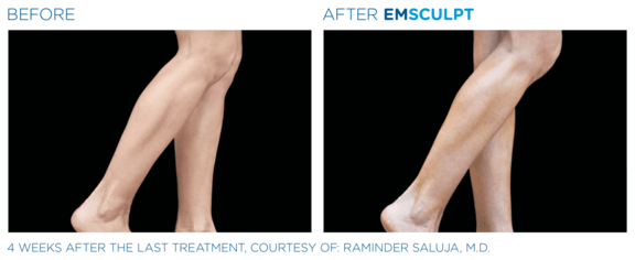 emsculpt-neo-vorher-nachher-05-info-aesthetik.png 