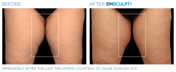 emsculpt-neo-vorher-nachher-04-info-aesthetik.png 