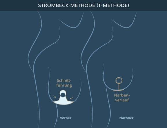 Graphik Brustverkleinerung T-Methode, info Ästhetik