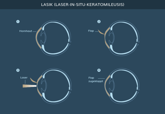 Graphik LASIK Augen Lasern, info Ästhetik