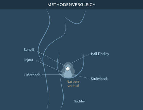 Graphik Brustverkleinerung Vergleich Methoden, info Ästhetik